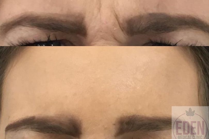 Win 1ml of filler plus a customised course of anti-wrinkle injectables from Eden Medical Clinic
